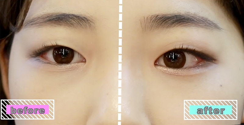 單眼皮 before & after｜美周報