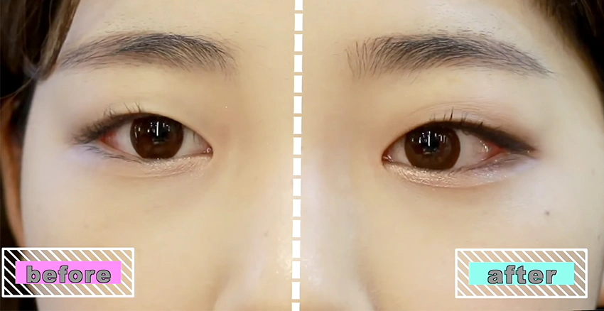 單眼皮 before & after｜美周報