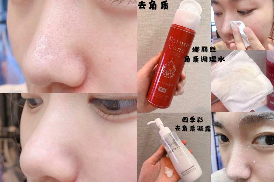粉刺 痘痘 保養知識文|美周報