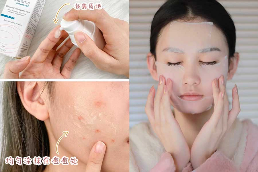 粉刺 痘痘 保養知識文|美周報