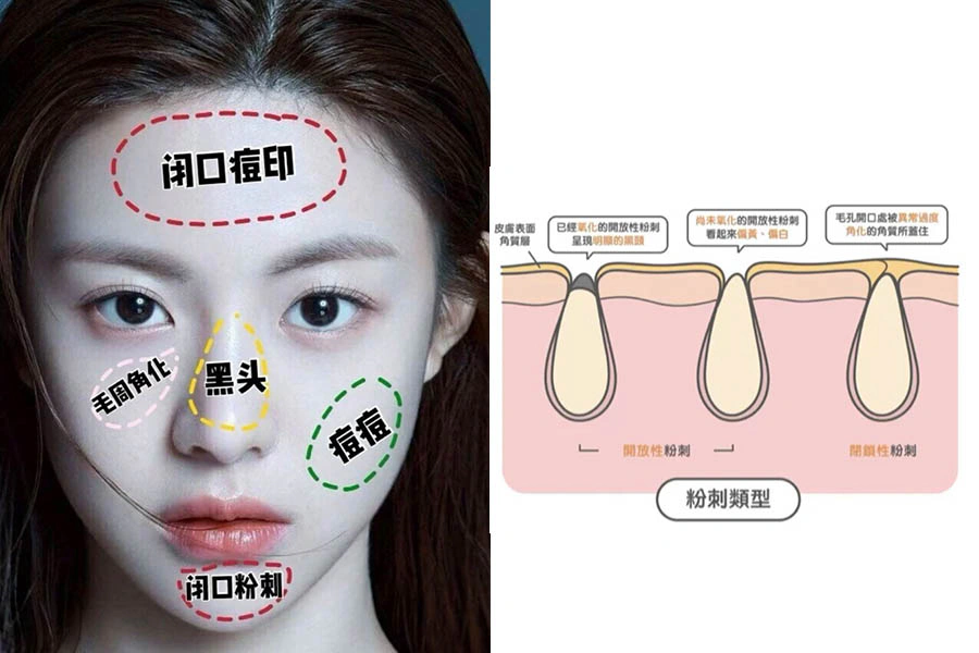 改善 去除 粉刺 痘痘 |美周報