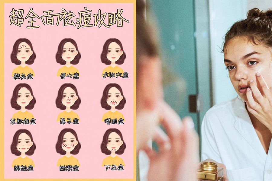 痘痘 青春痘 痤瘡 粉刺 治療 預防|美周報
