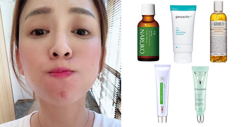 該死的內包痘痘怎麼還不消！網友推薦5款法寶，用完痘痘只能出來投降｜抗痘保養