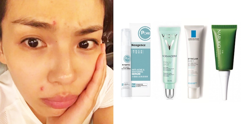 紅腫大痘痘消除法！網友大讚的4款「抗痘精華」消紅退痘最有感
