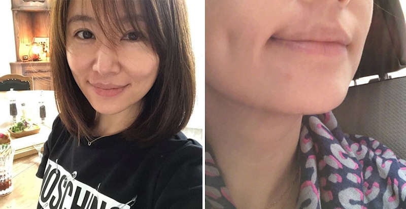 薄到不著痕跡！大紅痘瞬間隱形， 超薄痘痘貼必需入手｜痘痘貼推薦