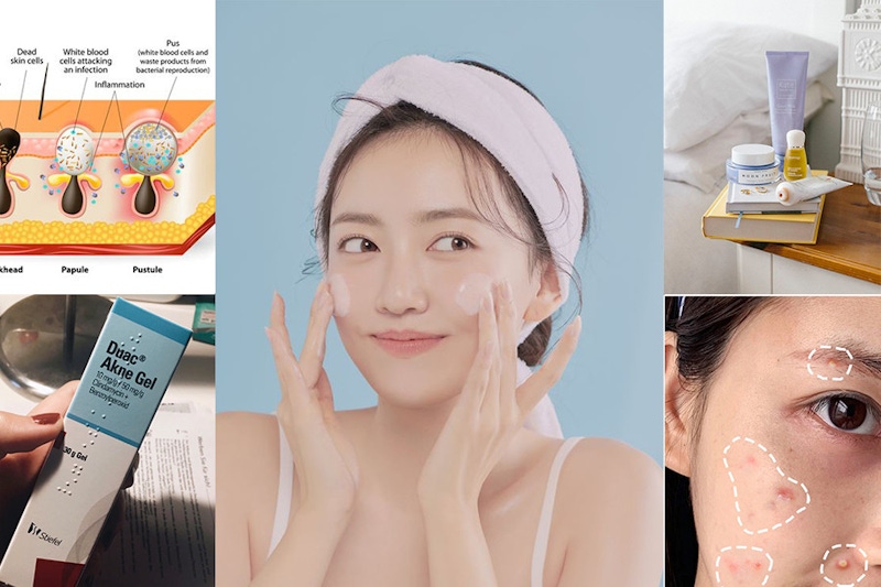 消滅青春痘前，先搞懂痘痘生成部位和原因，對症下藥痘痘龍再見！｜保養知識文